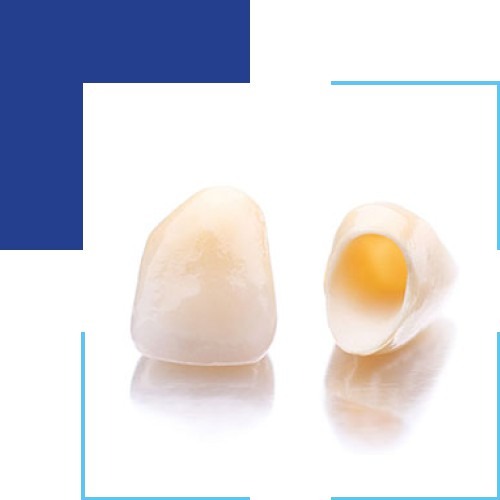 What to Do Before Getting Dental Veneers?